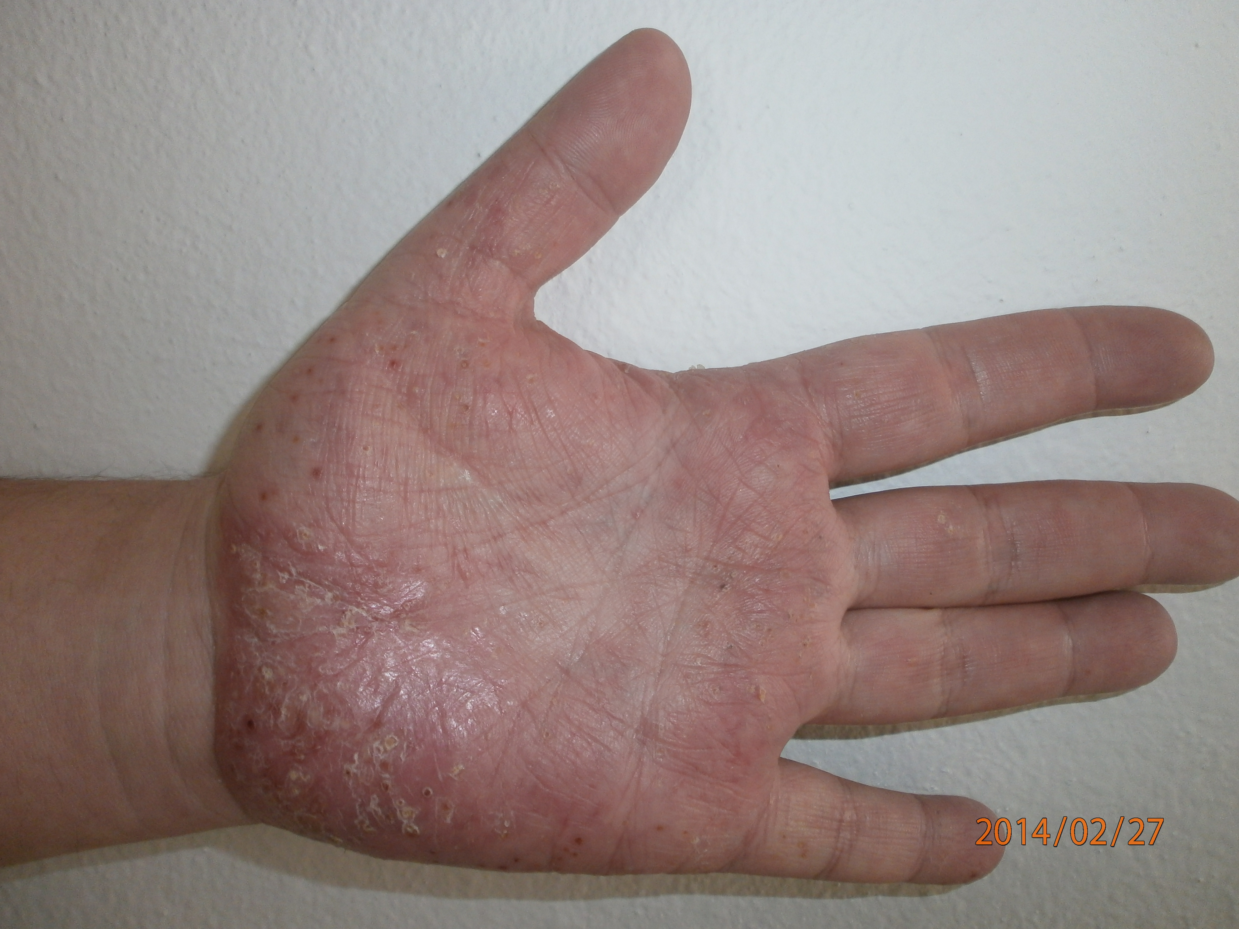Krónikus bőrbetegség psoriasis