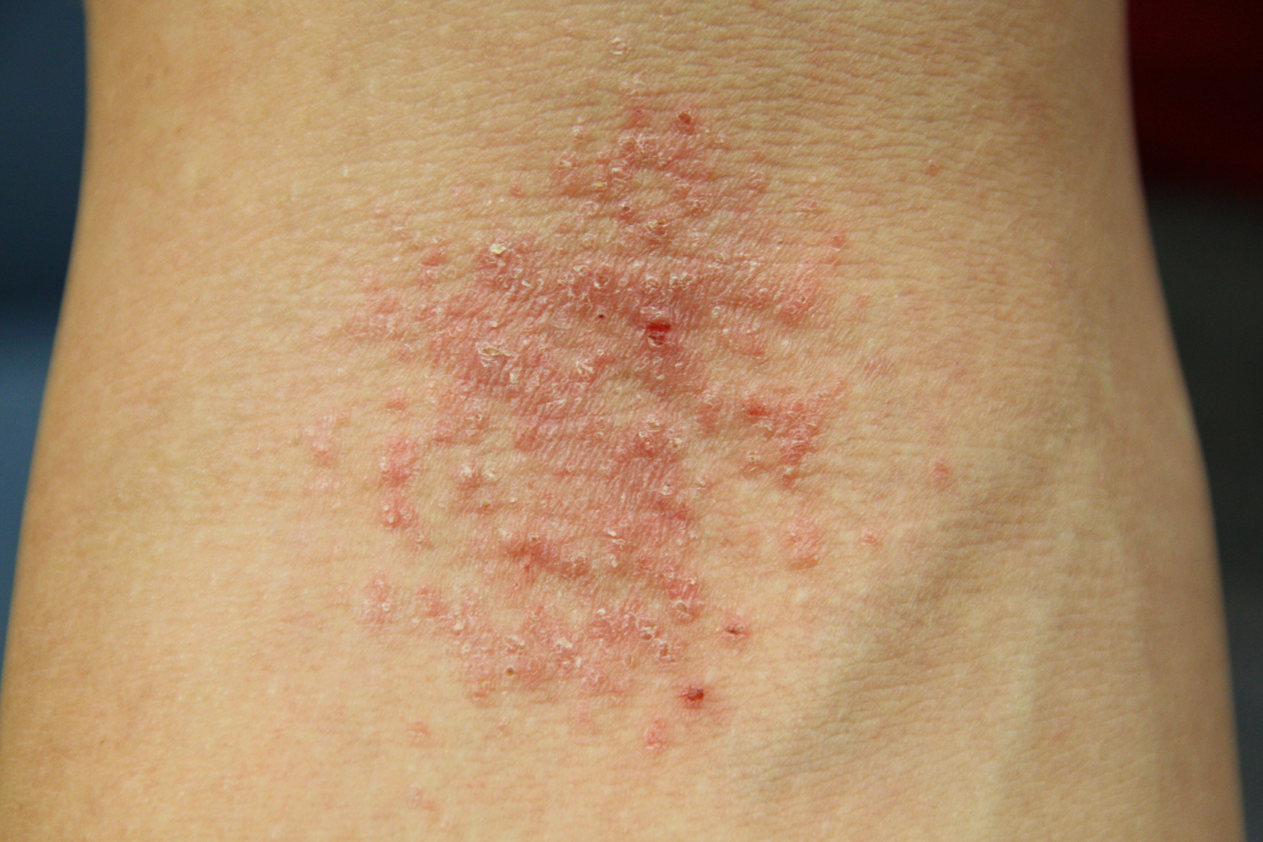 bőrbetegségek ekcéma pikkelysömör kezelése